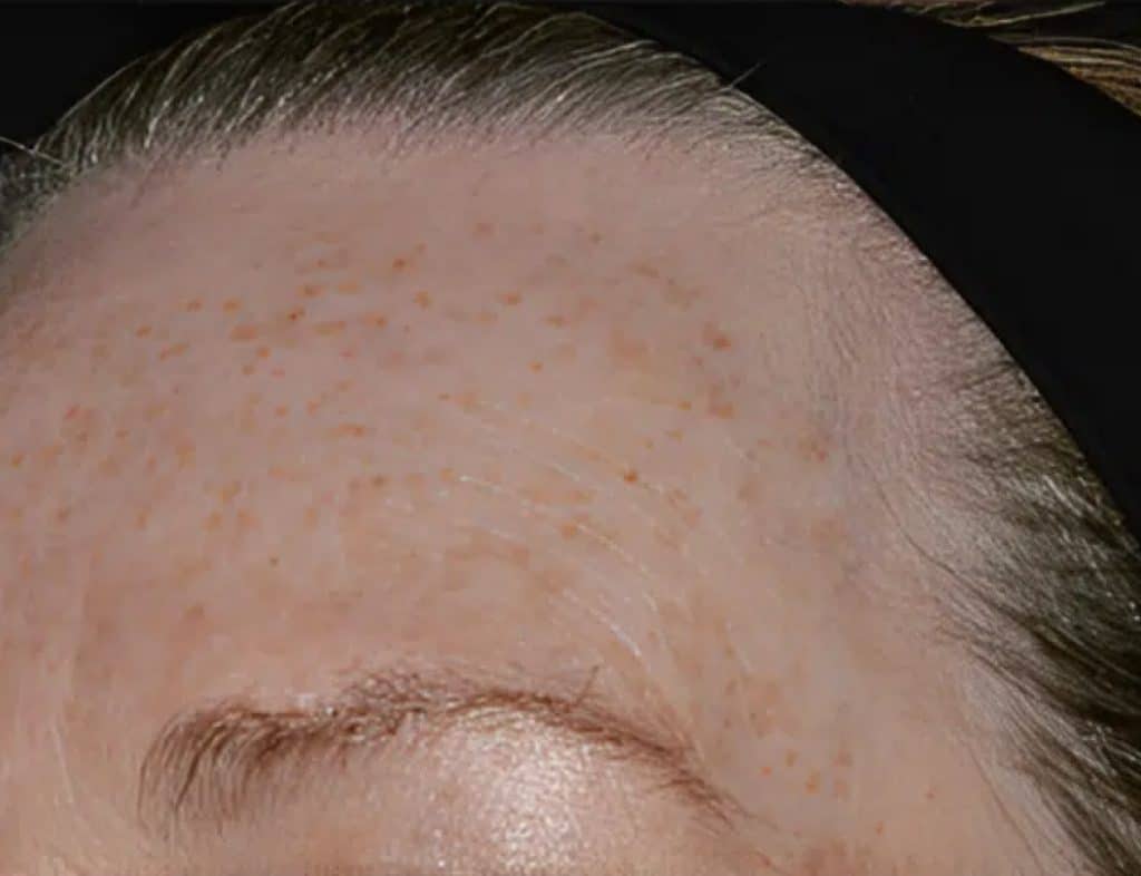 Medical Aesthetics before in garden city